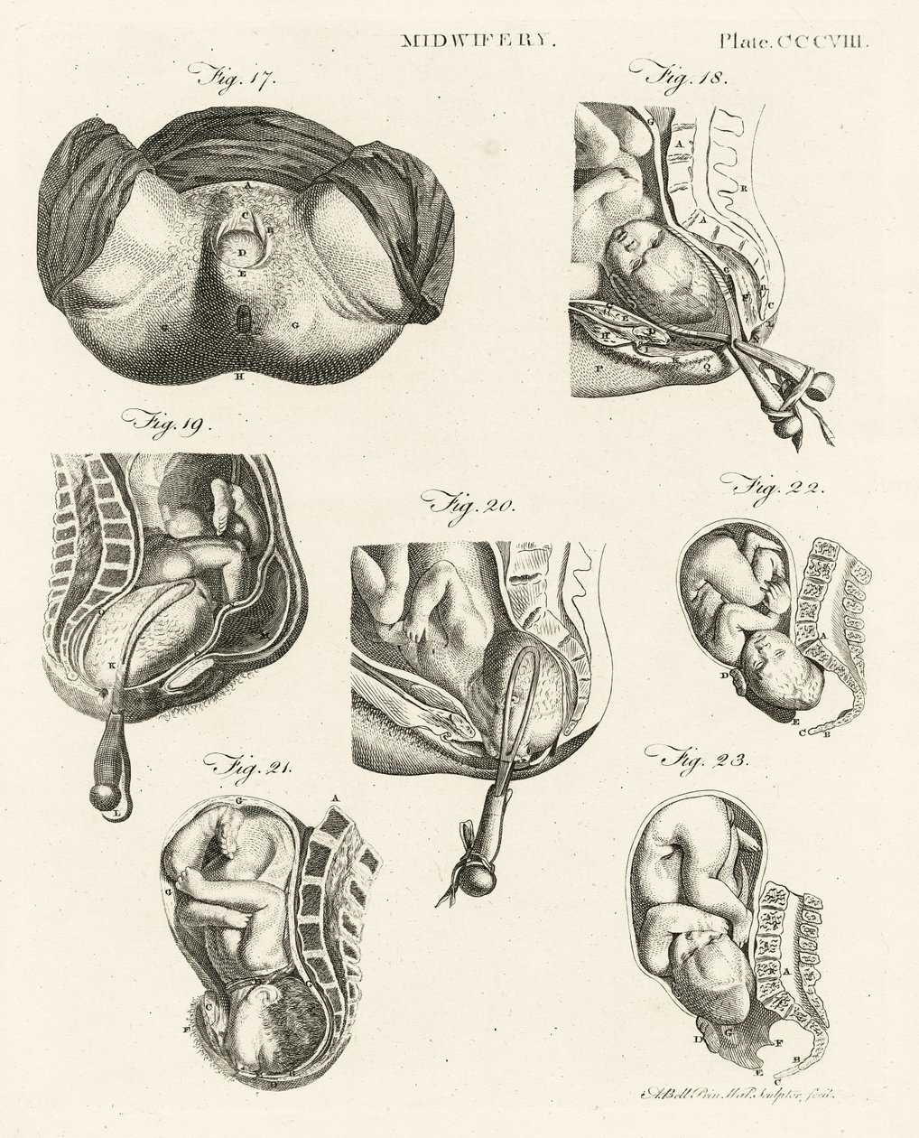 Porodnictví, ilustrace z 