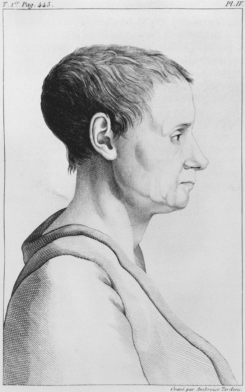 Theroigne de Mericourt, ilustrace z „Des Maladies Mentales zvažované sous le rapport medical, hygienique et medico-legal“ od Etienna Esquirola (1772-1840) deska IV, 1838 od Ambroise Tardieu