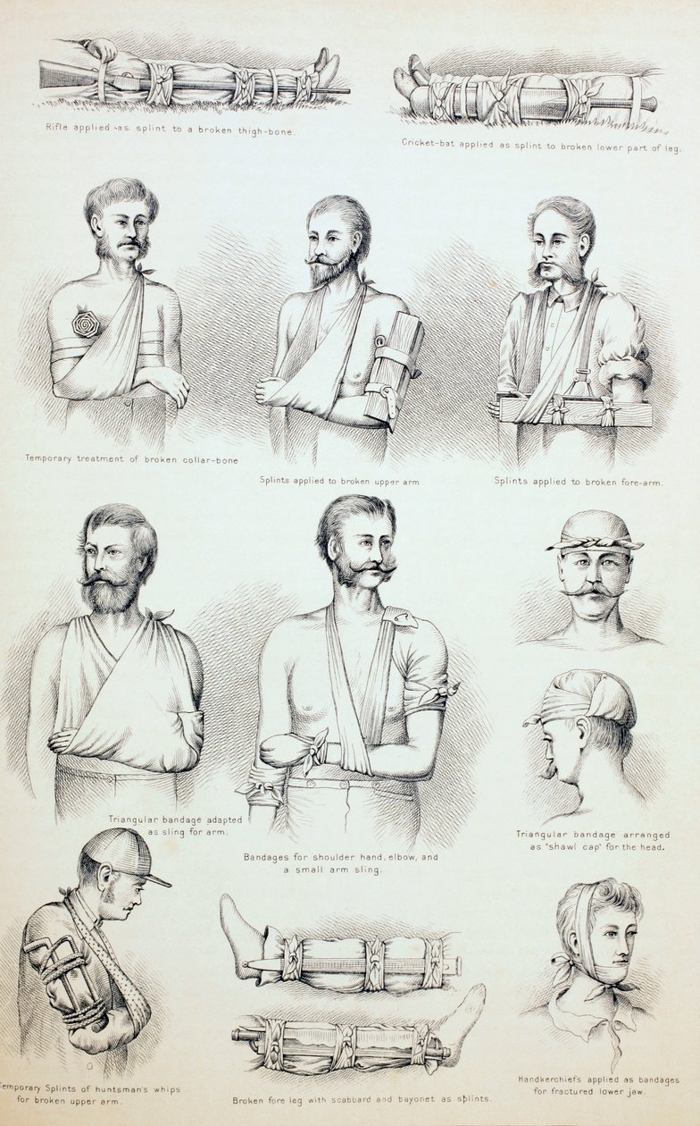 Dočasná léčba zlomenin, c.1890 od English School