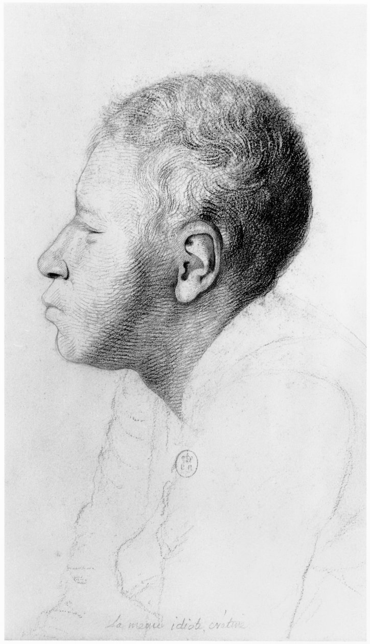 Cretin, profil, ilustrace z nepublikovaného pojednání Jean Etienne Dominique Esquirol (1772-1840) o šílencích z blázince Salpetriere, kolem roku 1818 od Georges Francois Gabriel