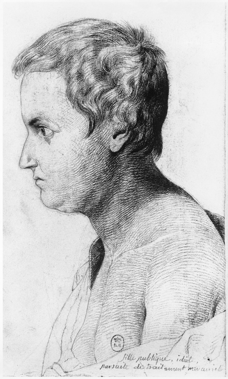 Idiotická prostitutka trpící syfilidou, ilustrace z nepublikovaného pojednání Jean Etienne Dominique Esquirol (1772-1840) o šílencích z blázince Salpetriere, kolem roku 1818 od Georges Francois Gabriel