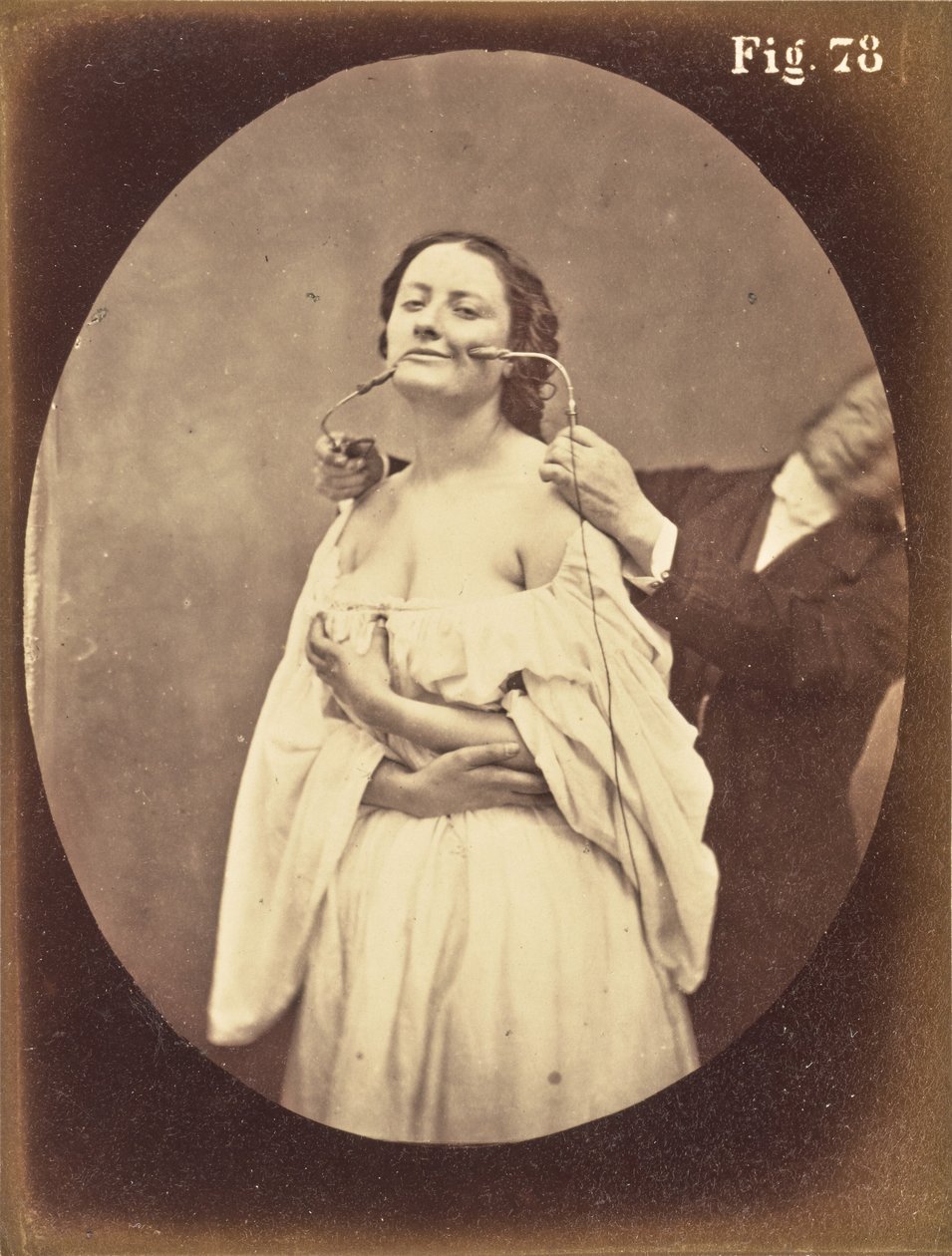 Obr. 78 od Guillaume Benjamin Duchenne