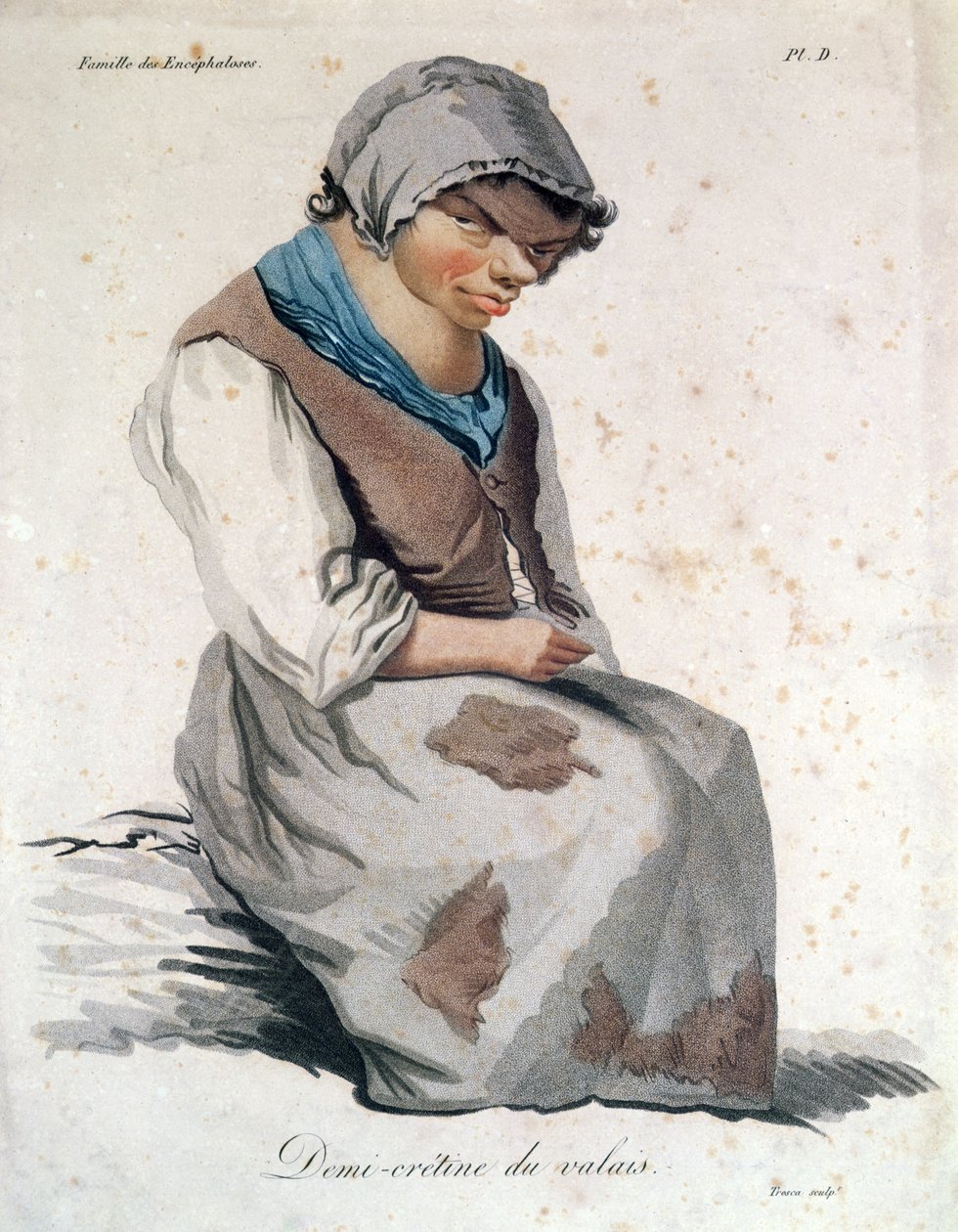 Cretin z Valais (barevná rytina) od Salvadore Tresca