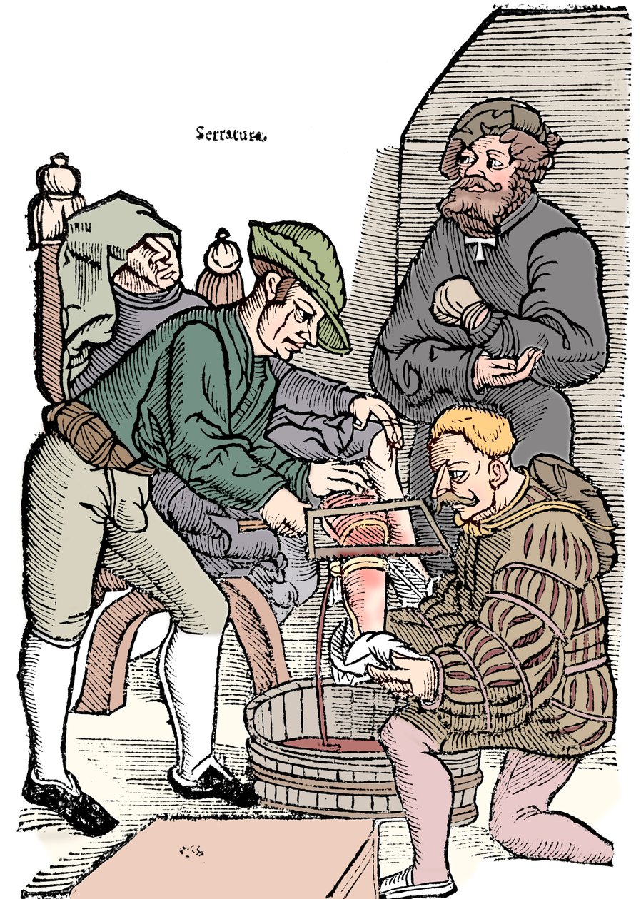 Amputace nohy bez anestetika, 1593 od Unbekannt