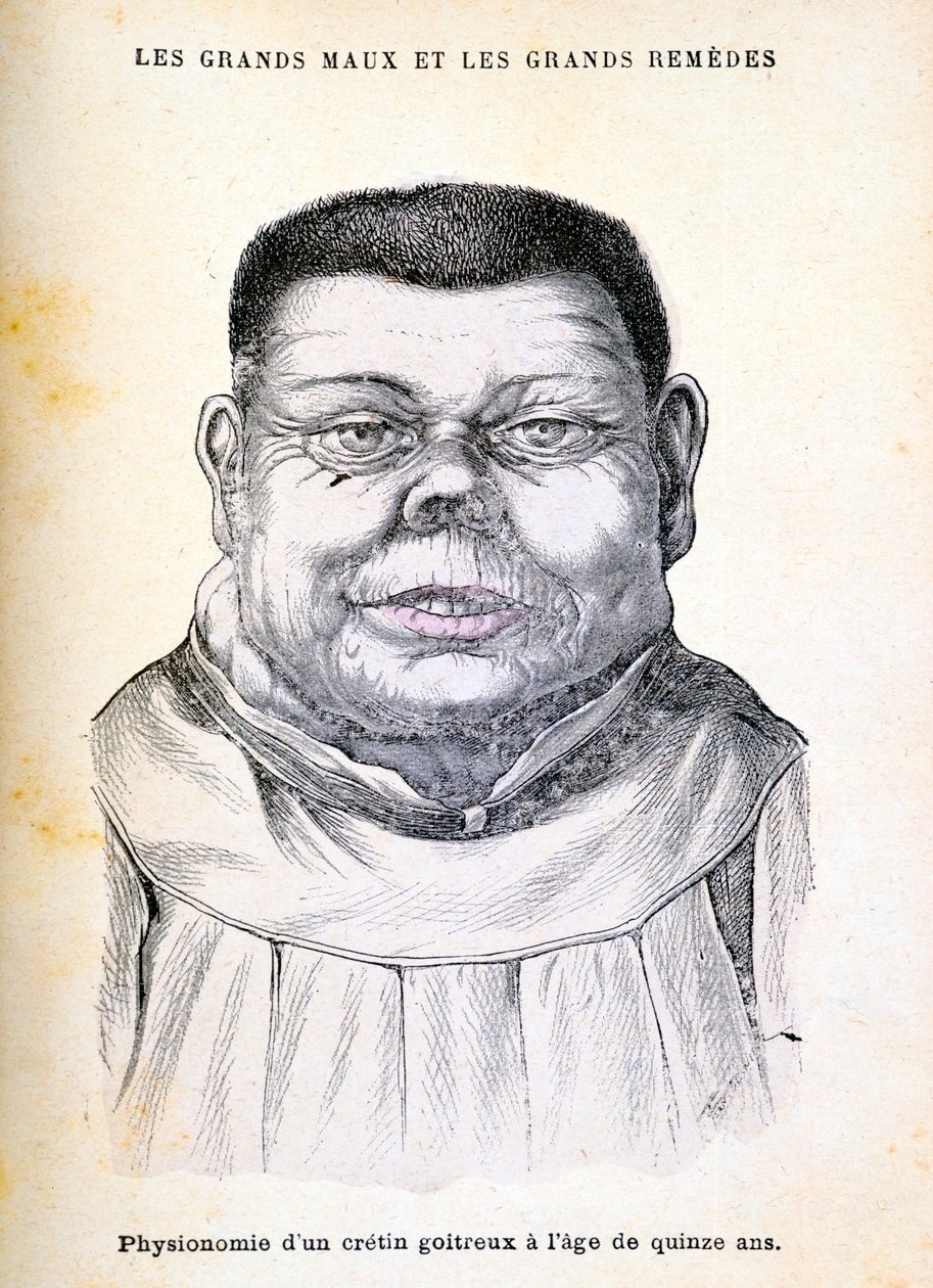 Cretin ve věku 15 let, c1890 od Unbekannt
