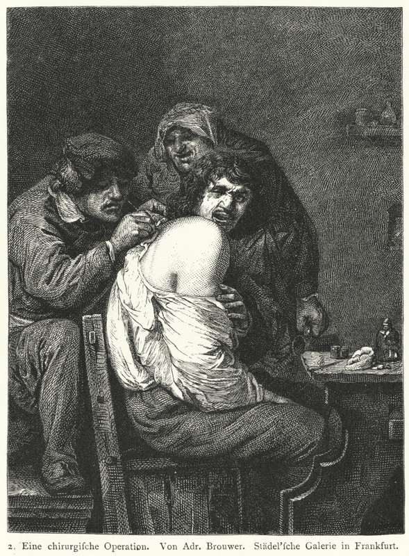 Operace zad od Adriaen (after) Brouwer