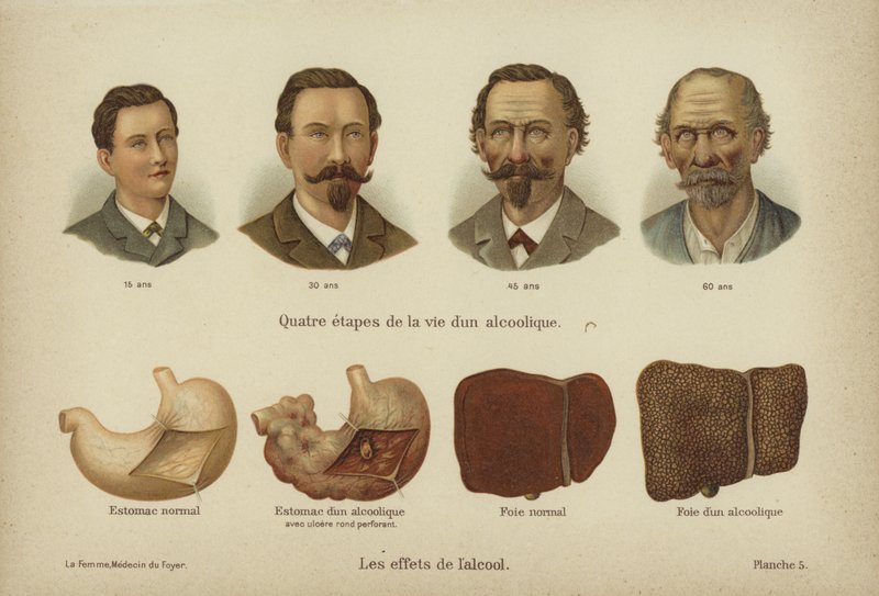 Účinky zneužívání alkoholu (color litho) od German School